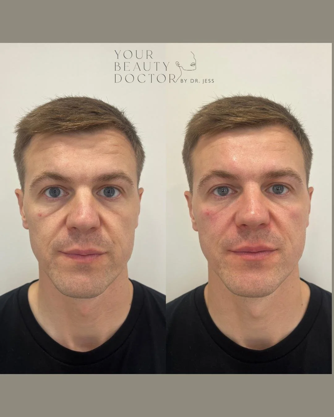 under eye correction Nottingham