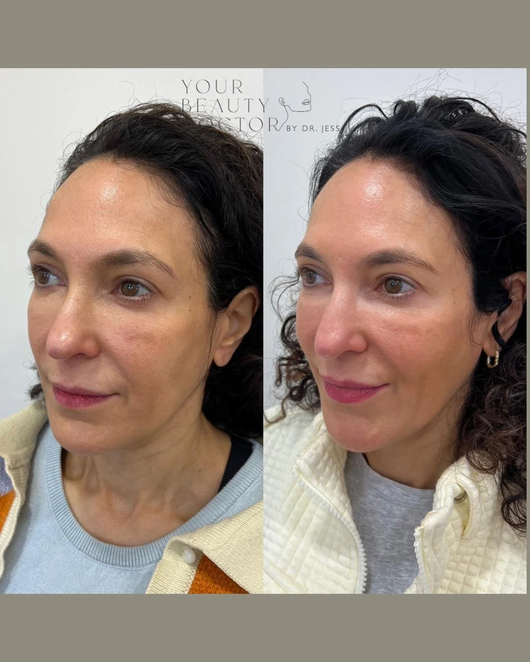 Face rejuvenation after weightloss Nottingham