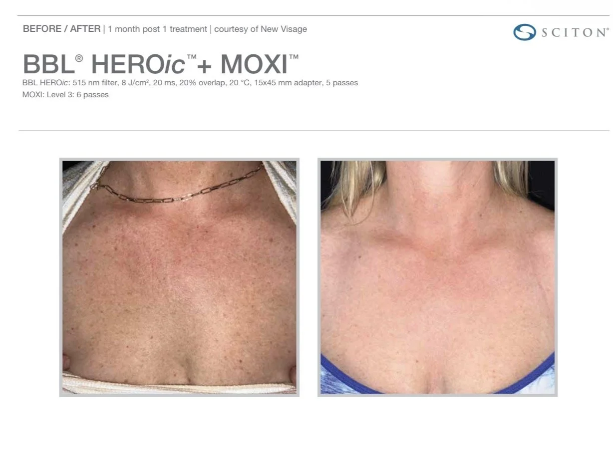 Skin pigmentation treatment Nottingham