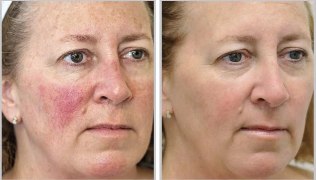rosacea treatment Nottingham