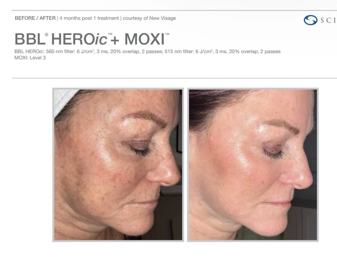 BBL HEROic skin treatment Nottingham