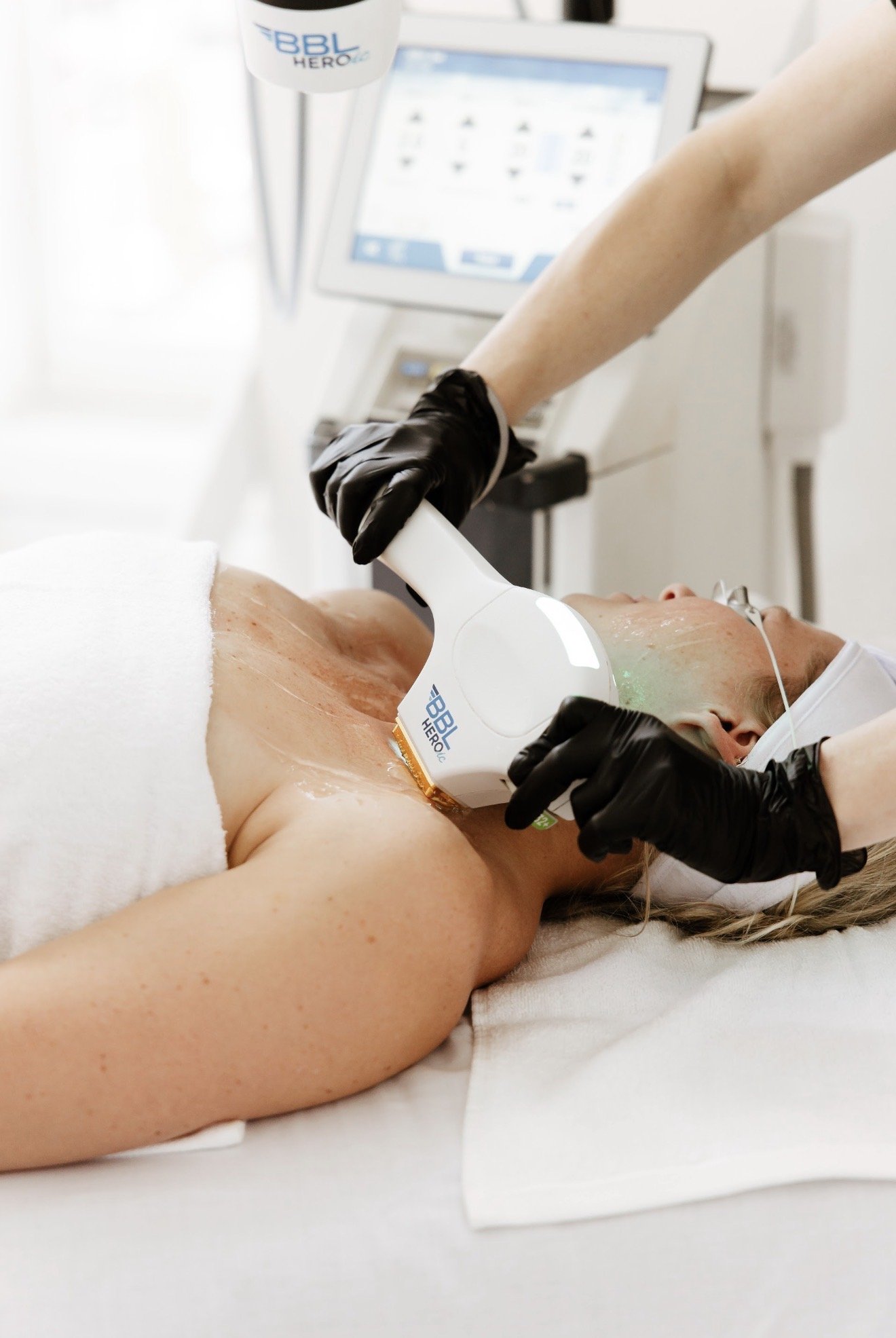 laser skin treatment for rosacea nottingham