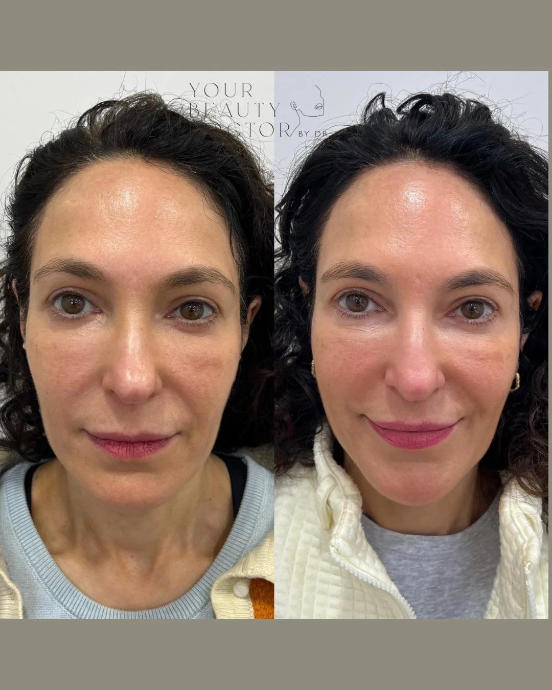 Face rejuvenation after weightloss Nottingham