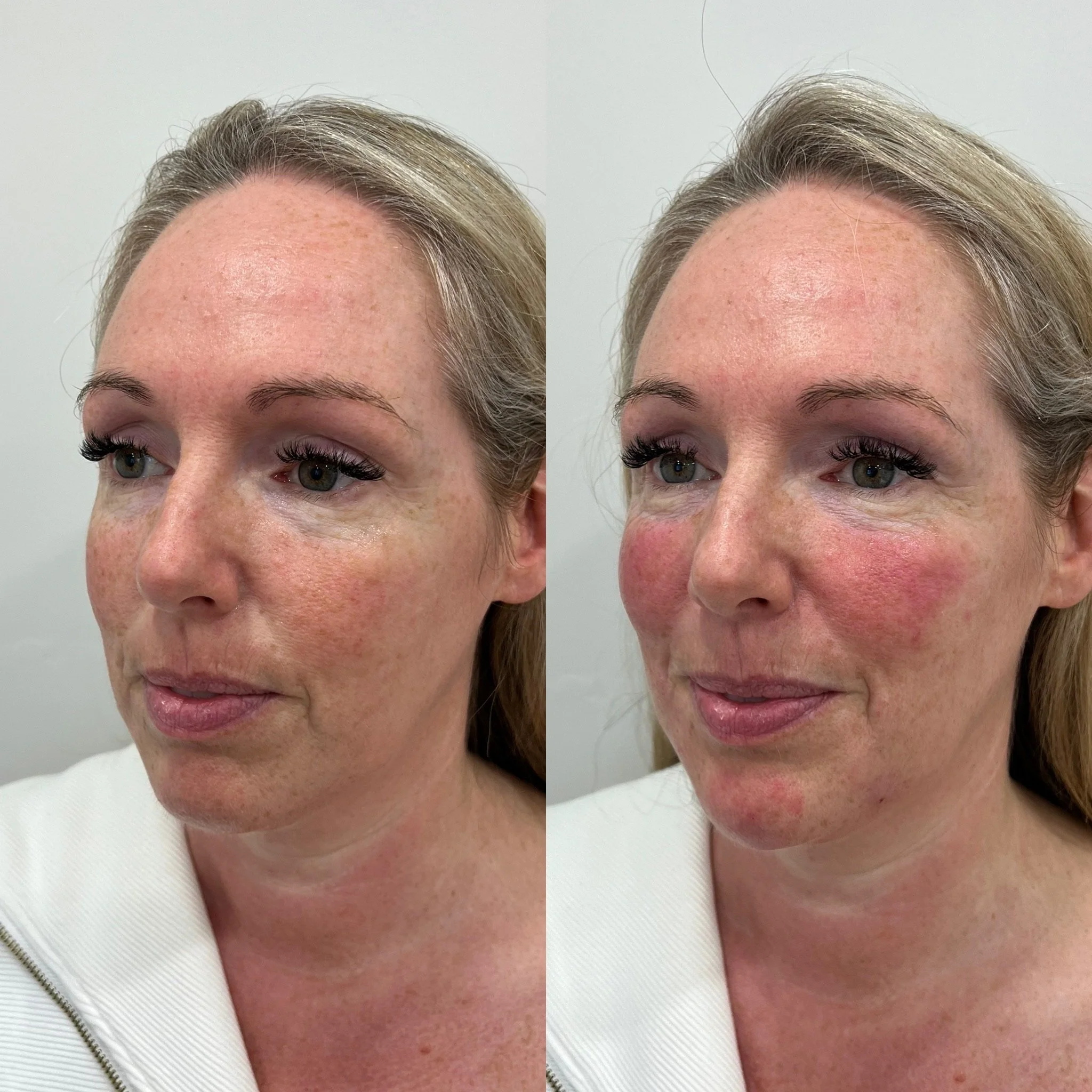 skinpen microneedling Nottingham