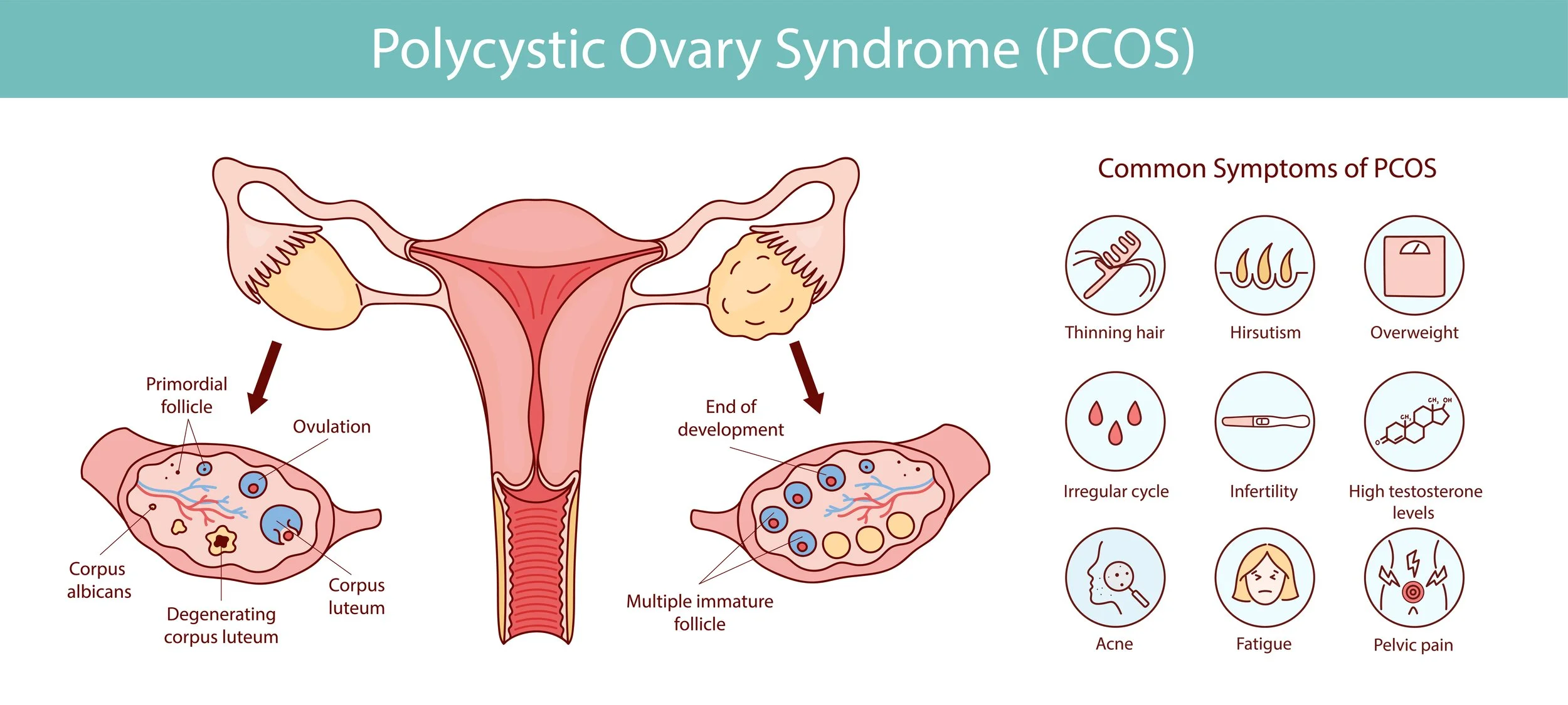 What Is PCOS? A Hormone-Based Explanation (Beyond the Ovaries)