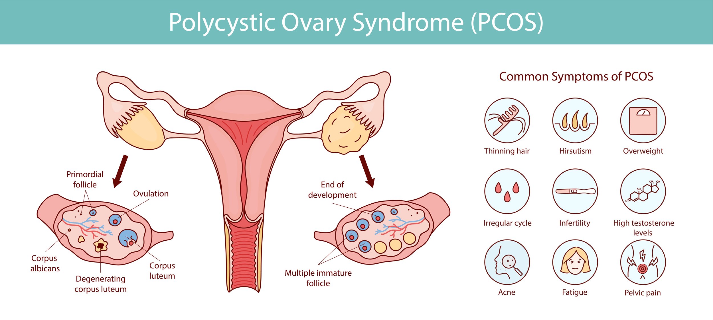 Diagram illustrating polycystic ovary syndrome (PCOS), showing disrupted ovulation, multiple immature ovarian follicles, and common PCOS symptoms such as irregular cycles, high testosterone, acne, hair thinning, weight gain, fatigue, and infertility.