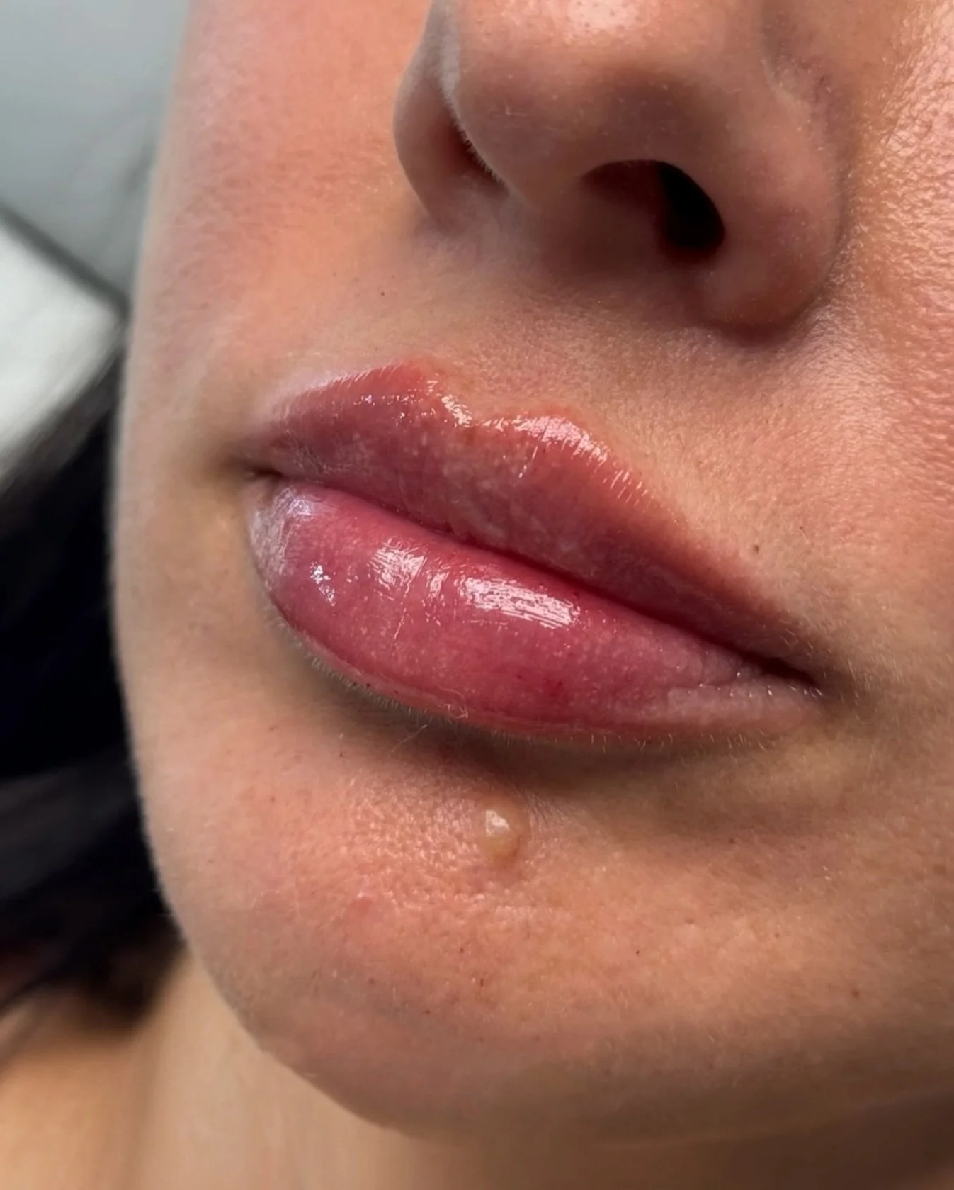 lowkey obsessed with how natural this lip filler turned out 💉

🤍 1 syringe
🤍pain free treatment with nerve block &amp; prescription strength topical numbing
🤍 complementary consultation to discuss goals and expectations

📍 Sacramento Injector | 