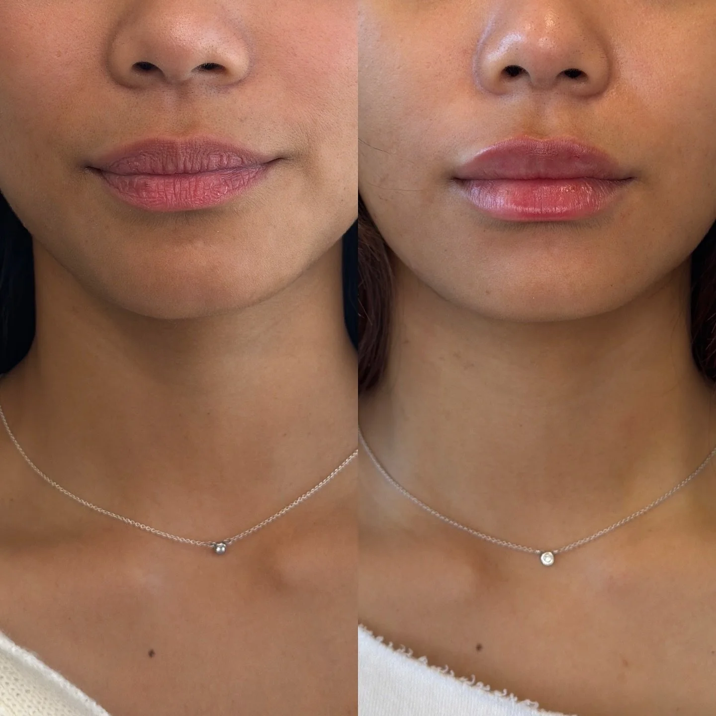 Lip Filler 👄 // 1 syringe

Hydration + soft volume for a refreshed look.
Filler placed to smooth texture, enhance shape, and keep proportions balanced and natural definition ✨

📍 Sacramento Injector | The Esthetics Bar
🍒CHERRY financing available
