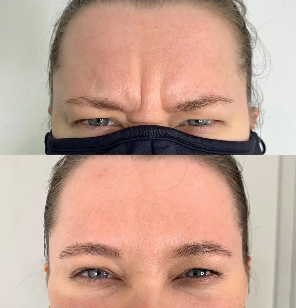BOTOX 2 WEEKS POST TREATMENT

Most people don&rsquo;t realize how much tension we hold right between the brows. Over time, that constant movement turns into deeper frown lines that stay, even when your face is at rest.

Neuromodulators (like Botox or