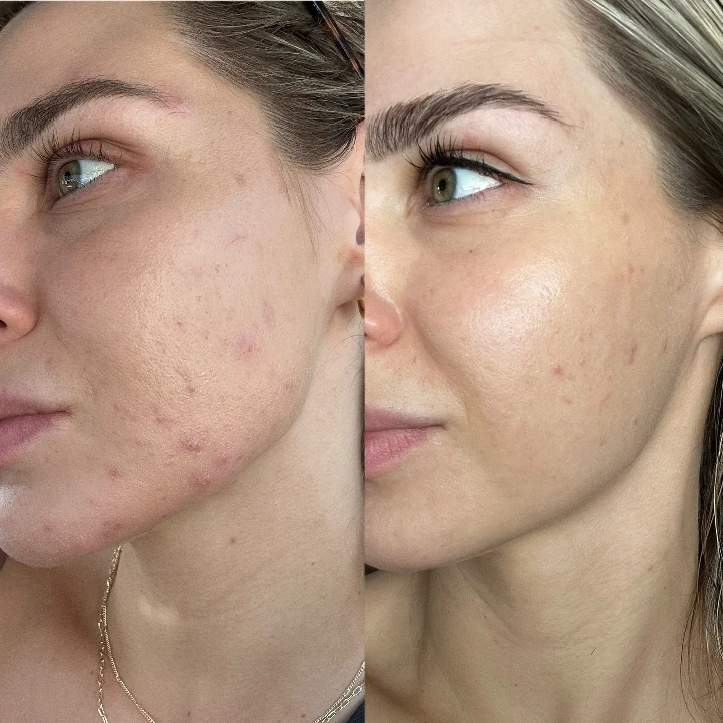 two peels, two months apart ✨

If you&rsquo;ve been searching for a skin treatment that truly delivers REAL results, the VI Peel might just be your new best friend. 

Benefits You Can Expect: 

✔️ Brighter, more even complexion
✔️ Reduced hyperpigmen