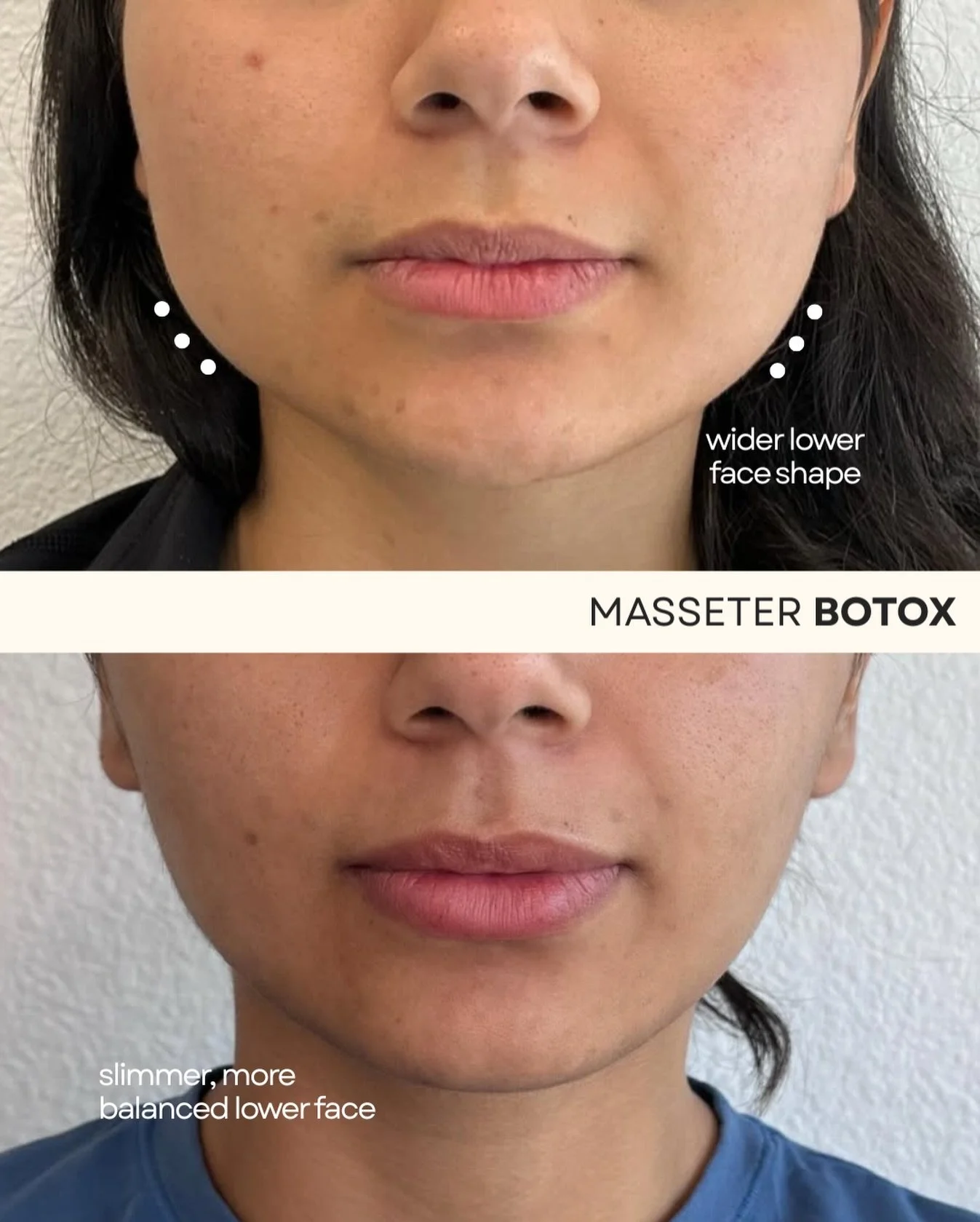 Masseter tox might be my most underrated favourite.

It&rsquo;s perfect for anyone who clenches or grinds their jaw, especially if you catch yourself doing it without even realizing. By relaxing those overworked muscles, you&rsquo;re not just changin