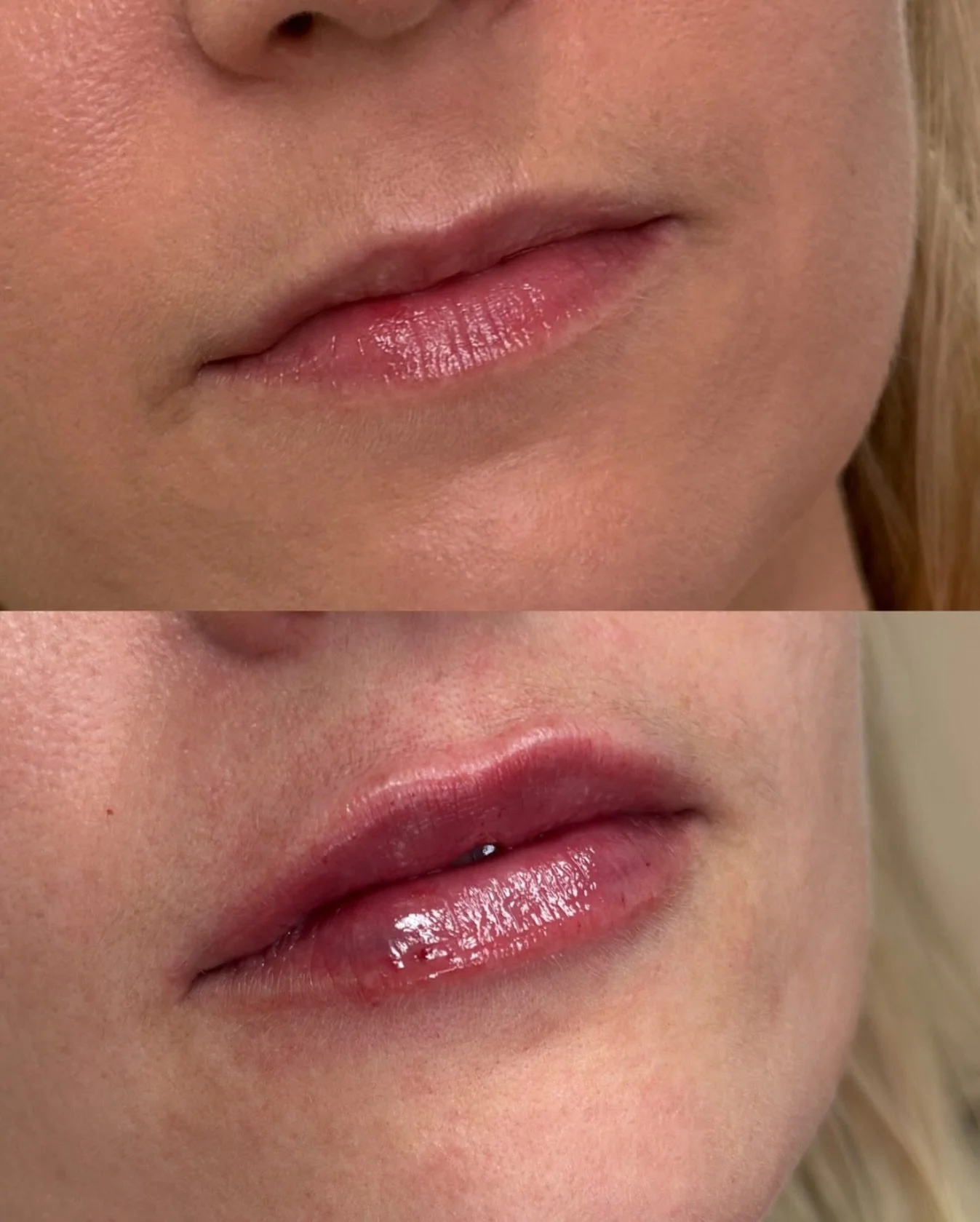 One syringe can do a lot. Just the right amount of volume, shape, and hydration.

It&rsquo;s the kind of change that feels soft, balanced, and still completely you. 💋

💌 Tap the link in bio to book your lip appointment.

📍 Sacramento Injector | Th