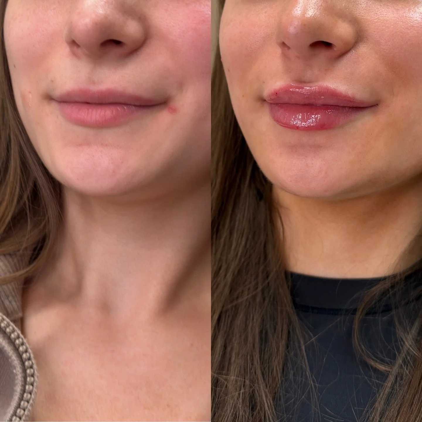 LIP FILLER BEFORE &amp; AFTER 💋

A soft enhancement that keeps your lips looking like you&hellip; just a little fuller, smoother, and more balanced.

We can add volume, correct asymmetry, define the border, or simply hydrate the lips if you prefer a