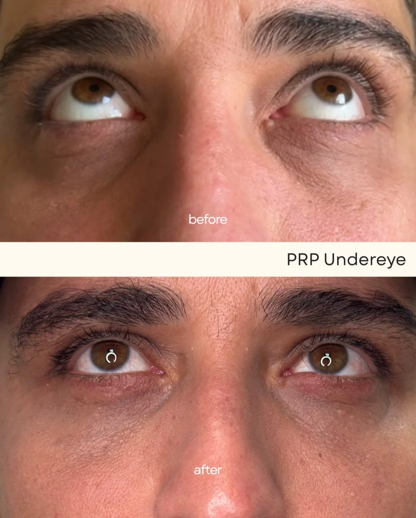 A softer under-eye is possible 🤍

PRP is one of my favorite ways to brighten and smooth this area without adding any volume.

It works by using your own growth factors to support the skin from within. Think: stronger skin, better texture, and a grad