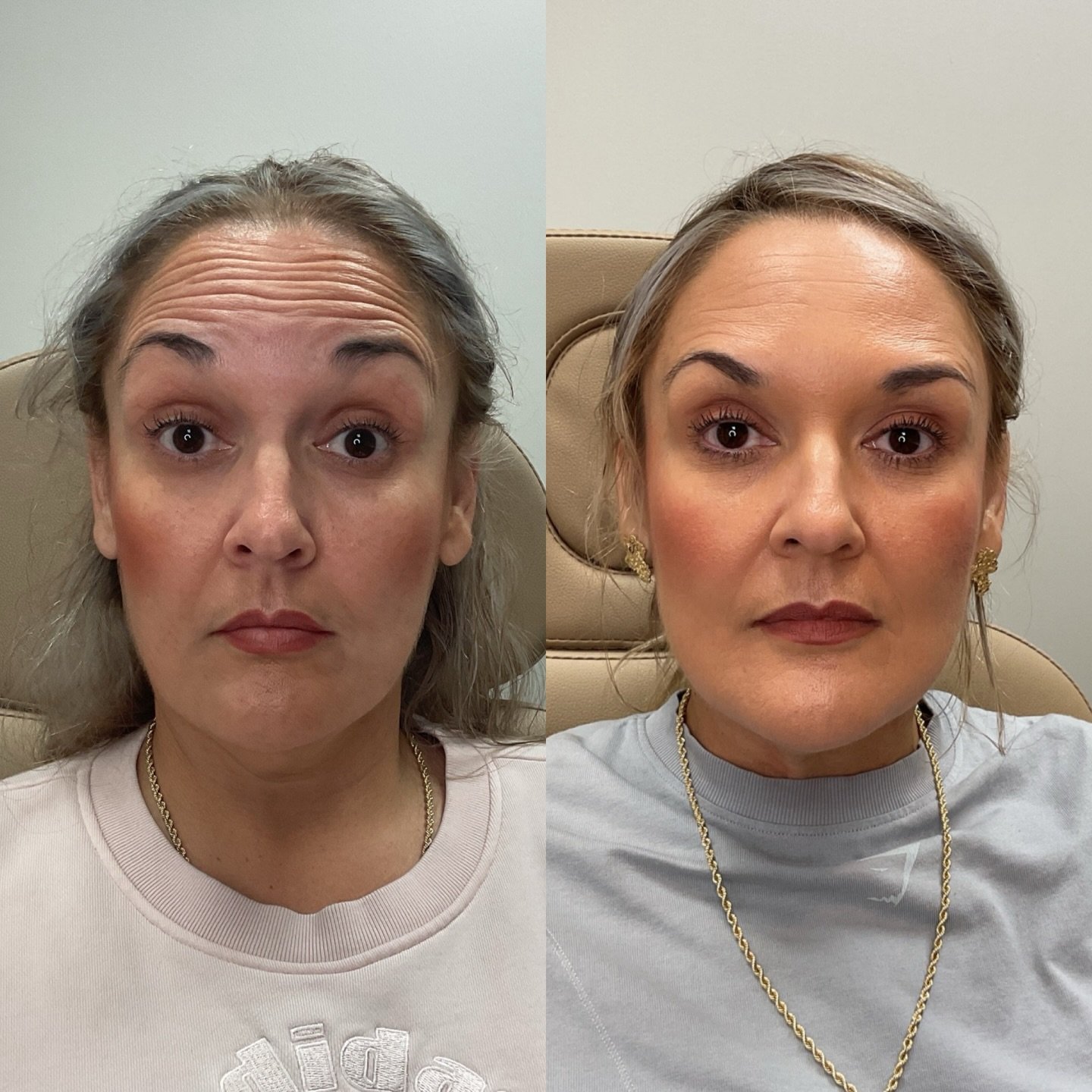 Forehead lines, frown lines, and crow&rsquo;s feet treated with intention, not excess.

The goal here wasn&rsquo;t to freeze anything, but to soften the areas that were creating tension while keeping her expressions natural and balanced.

Notice how 