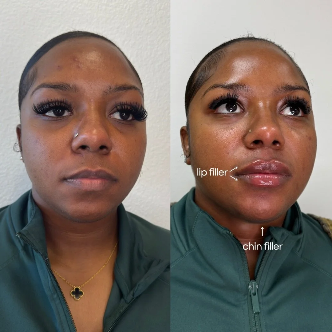 this one speaks for itself &amp; ✨ i&rsquo;m obsessed ✨ 

💌 DM or tap the link in bio to book a consult.
📍 Sacramento Injector | The Esthetics Bar
🍒 CHERRY financing available
💳 CARE CREDIT accepted
.
.
.
.
Sacramento injector, Sacramento medspa,