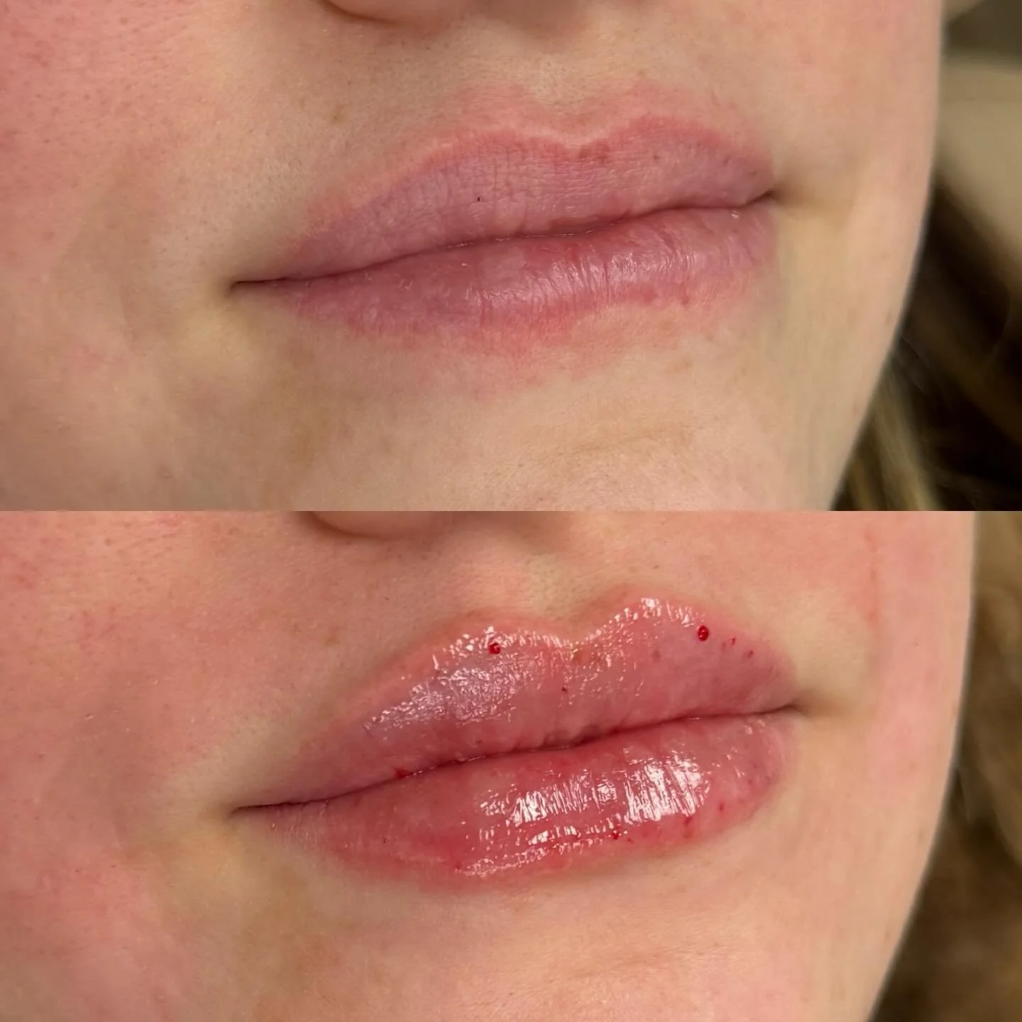 Subtle, natural lip filler for a first timer focusing on maintaining her shape while adding soft volume.

Proof that &ldquo;done&rdquo; doesn&rsquo;t have to look overdone 💋