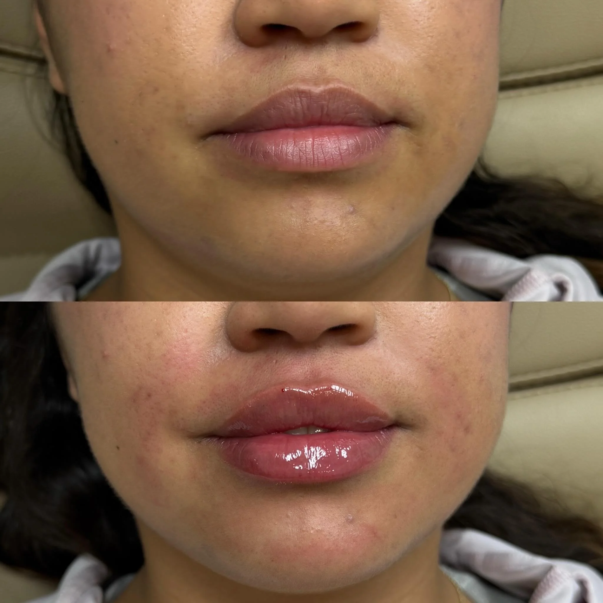 Your lips, but JUCIER 👄

Even when lips are naturally full, strategic filler placement can enhance shape, improve symmetry, and boost hydration for a beautifully balanced result.

For this client, we focused on increasing vertical height, refining a