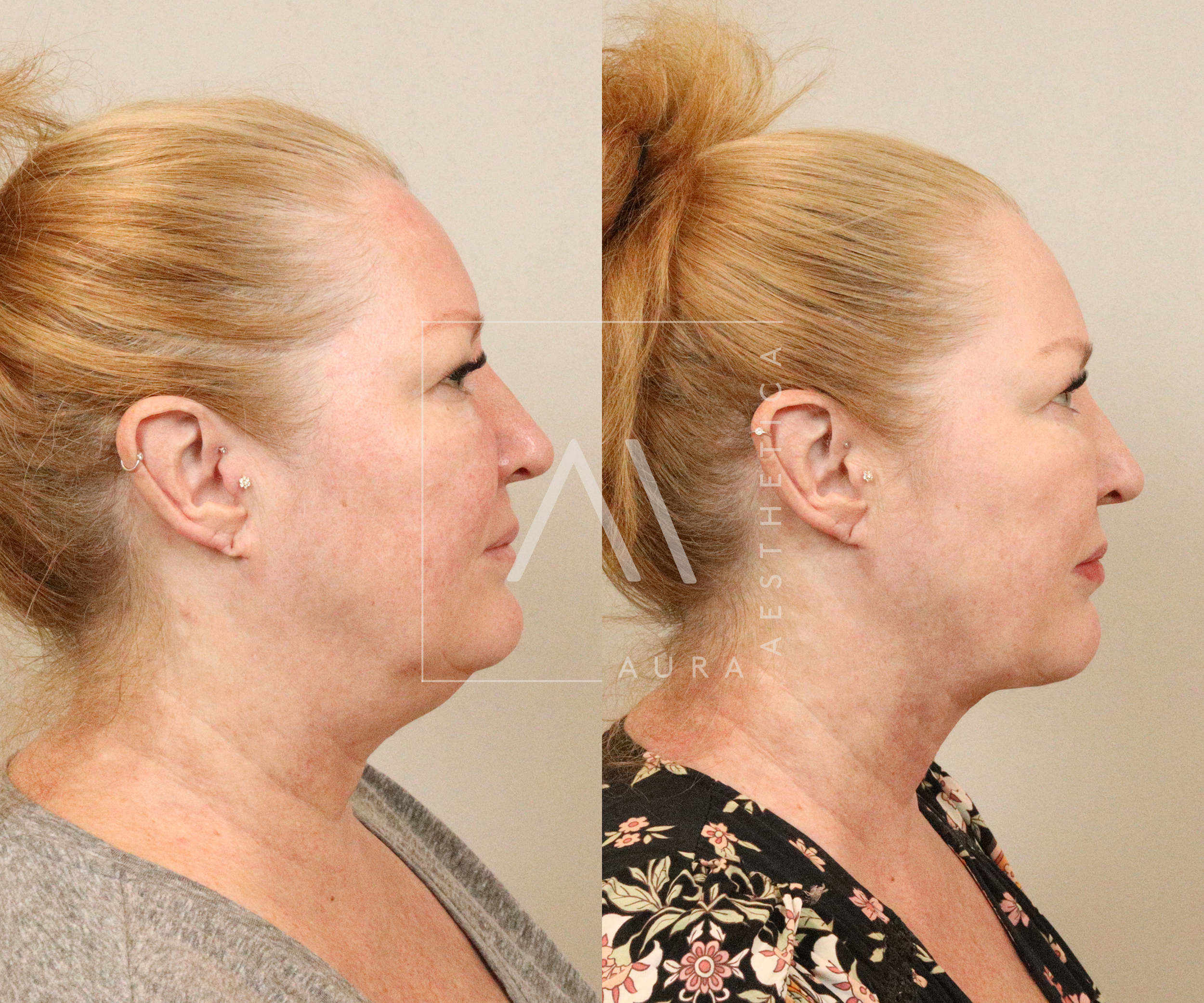 Side-by-side comparison of a woman before and after facial treatment showing improved skin texture and reduced wrinkles.