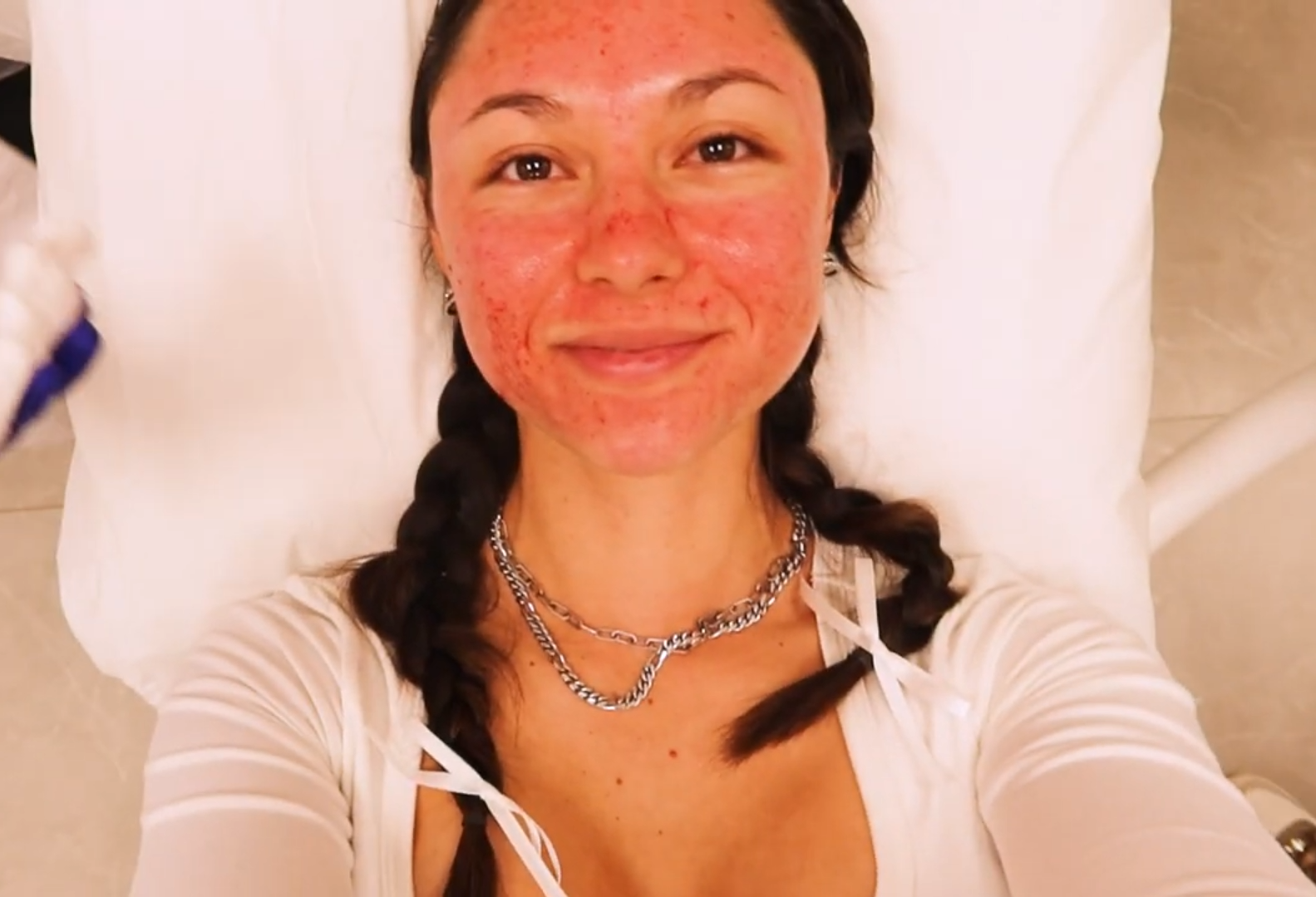 What microneedling for the first time was actually like