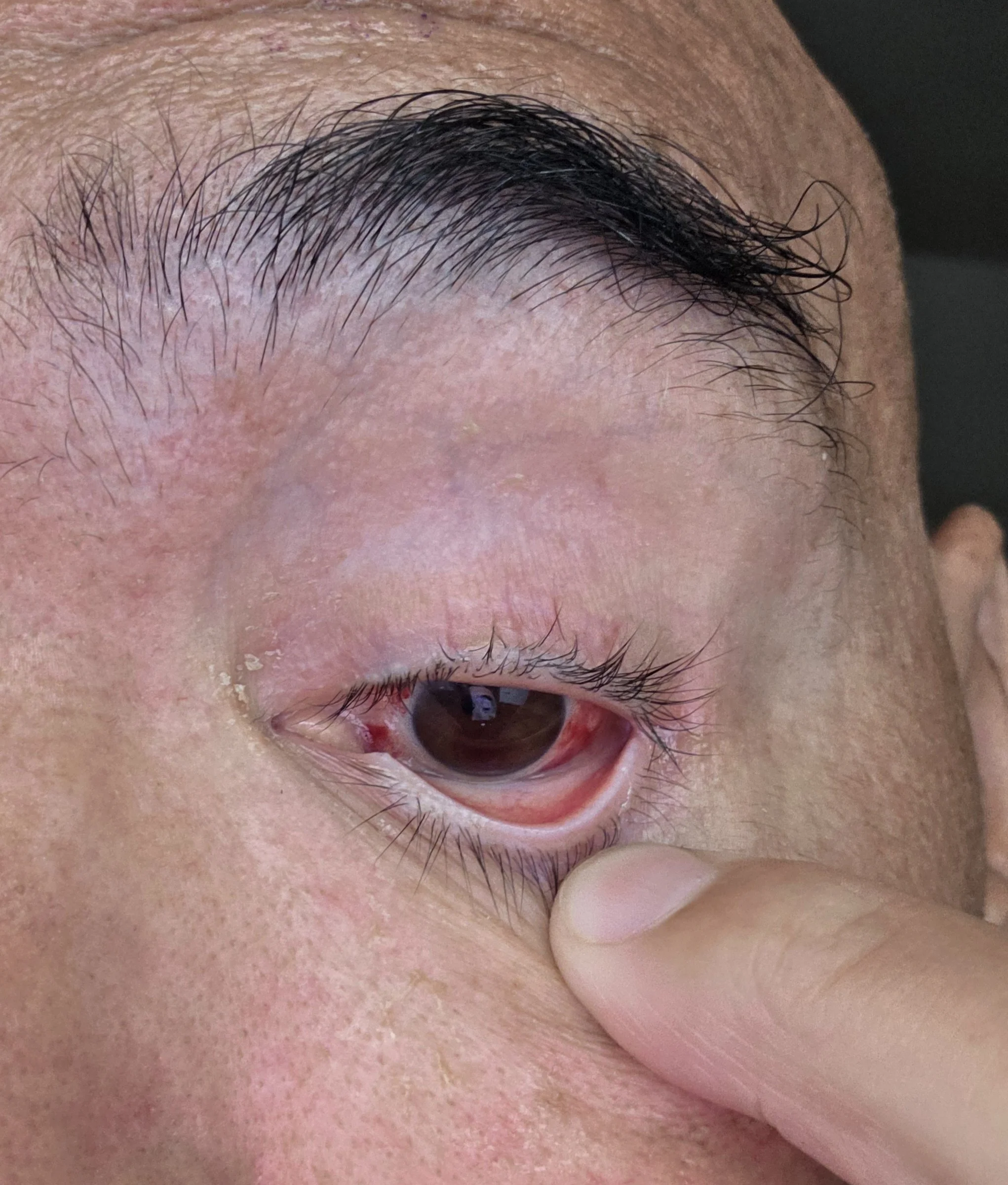 Day 2: My Eye Has Seen Better Days 👁️