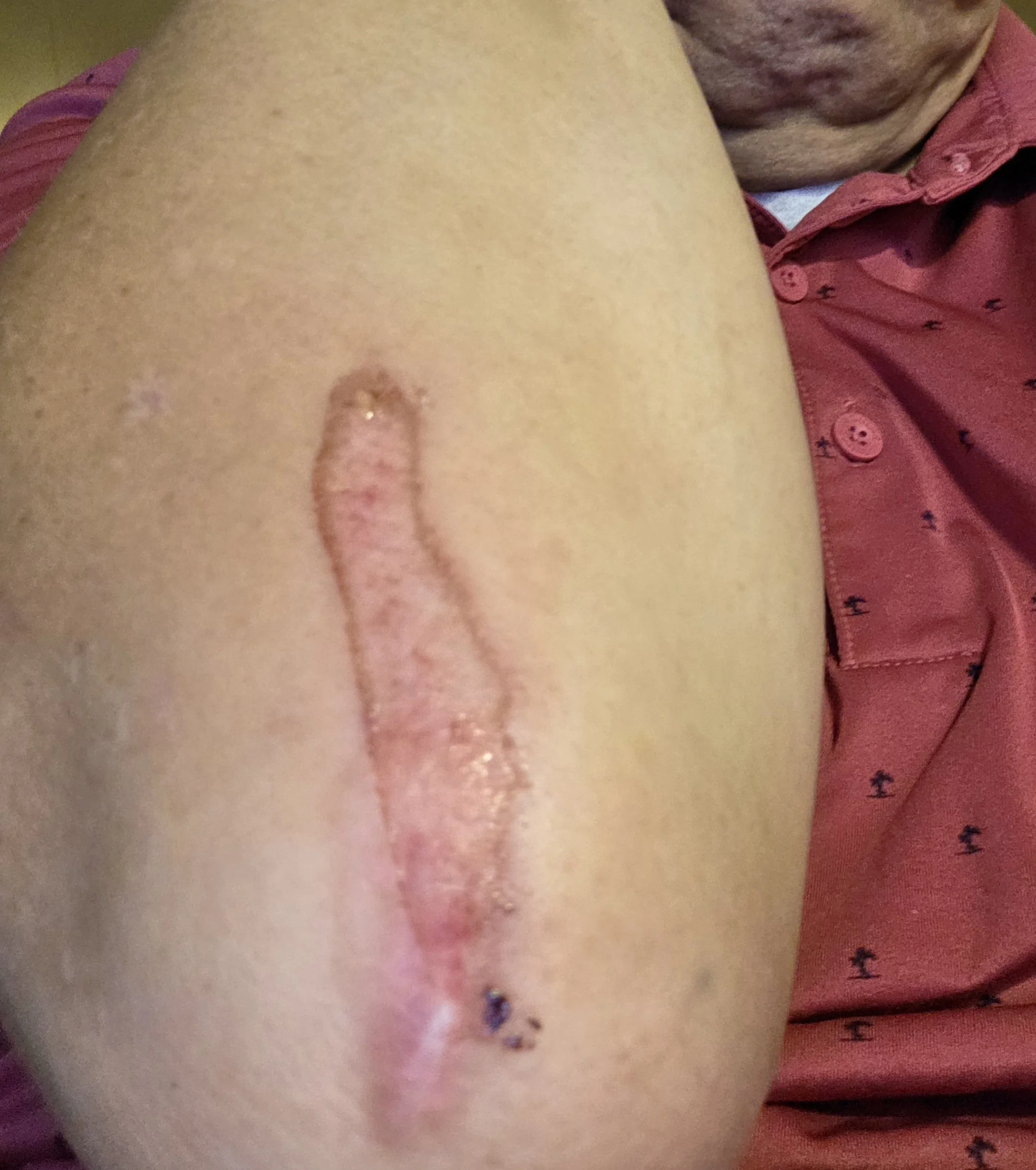 Gravity Wins Again: When My Prosthetic Decided We Were Falling