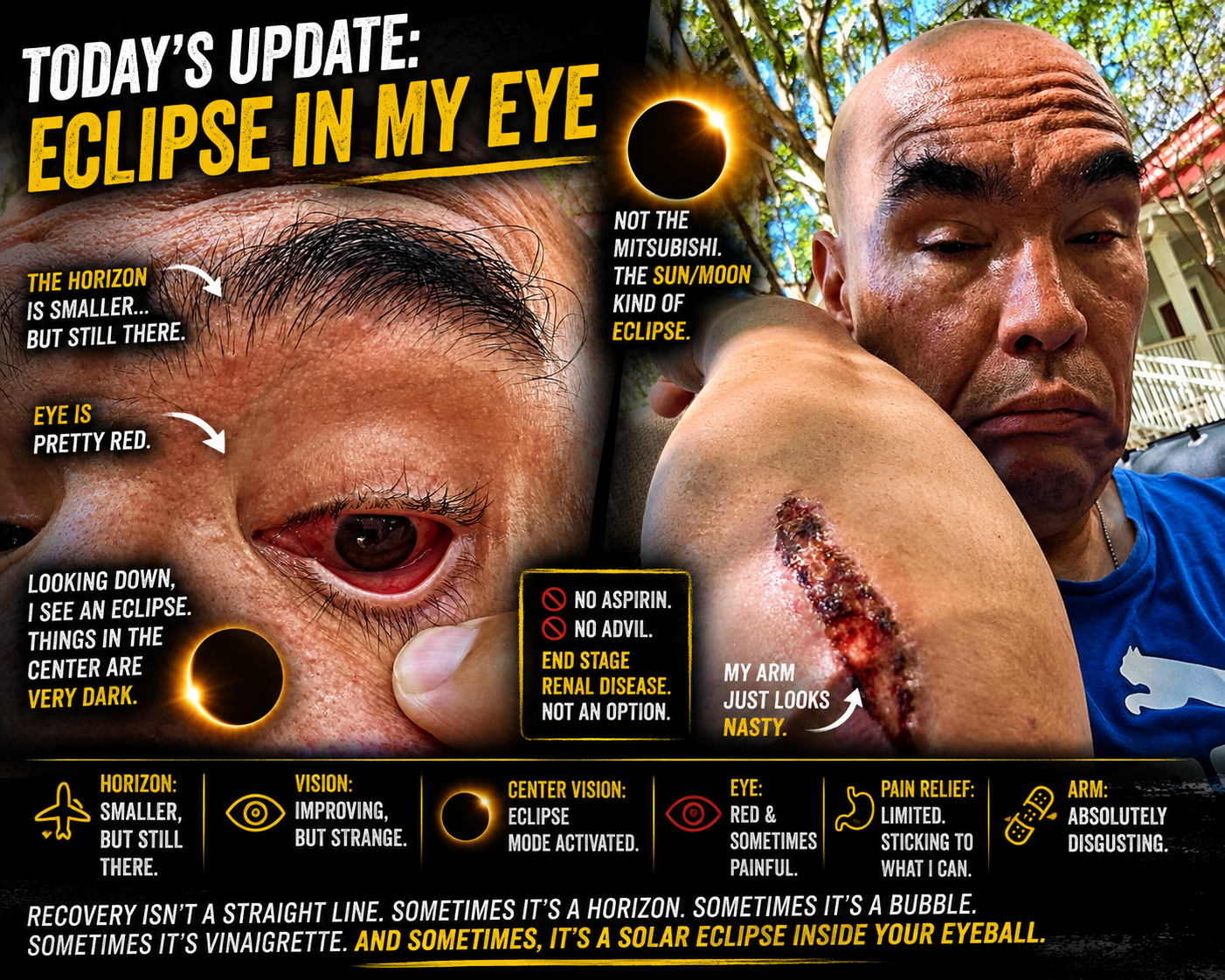 Apparently, My Eye Has an Eclipse Now