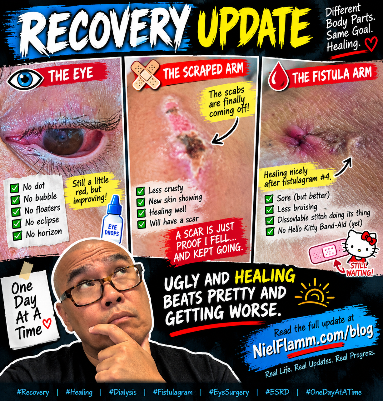 Recovery Update: The Scabs Are Leaving, the Scar Is Staying