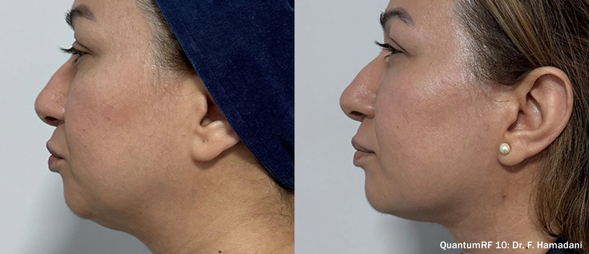 Photos courtesy of InMode.