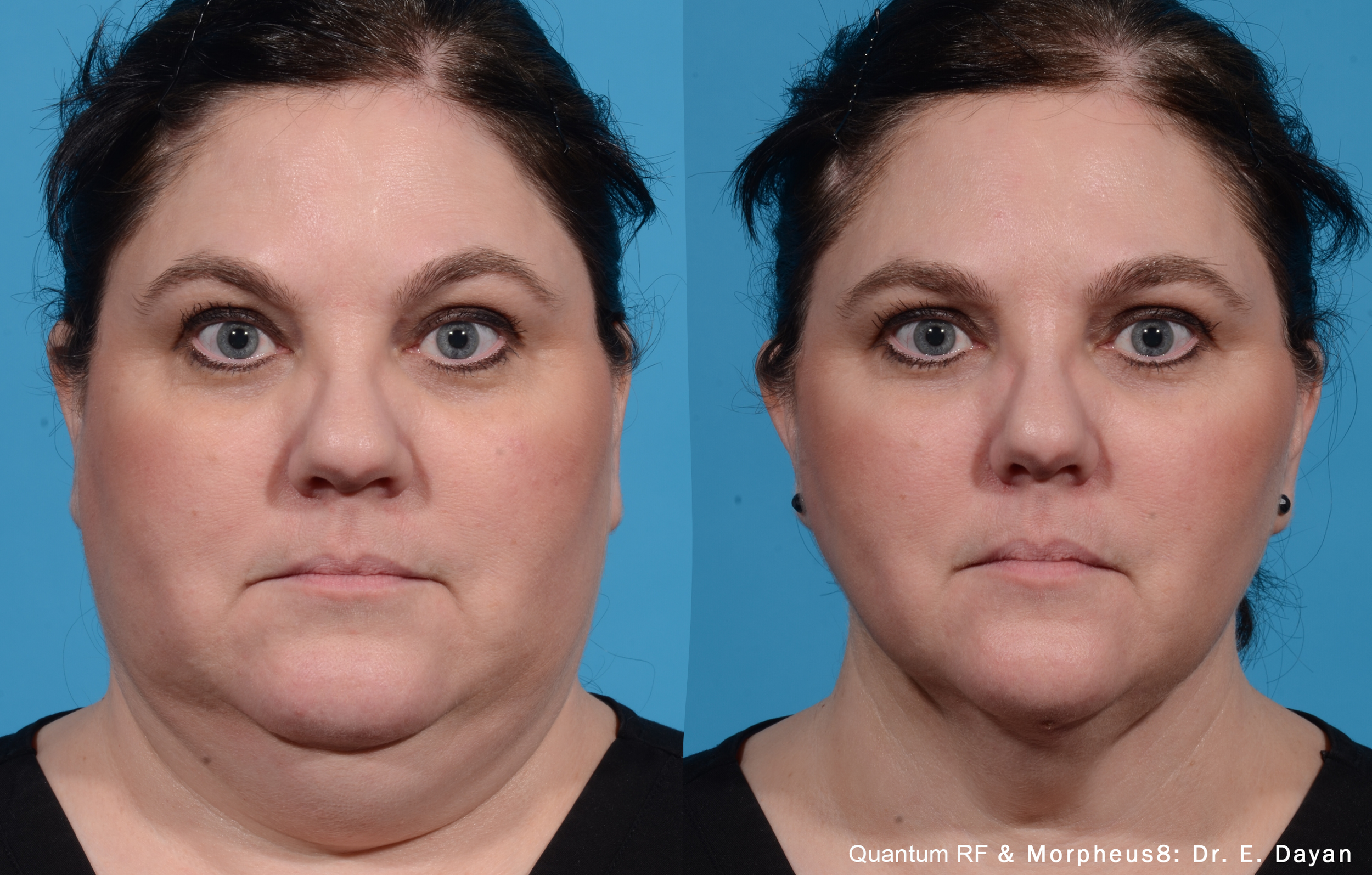 Photos courtesy of InMode.