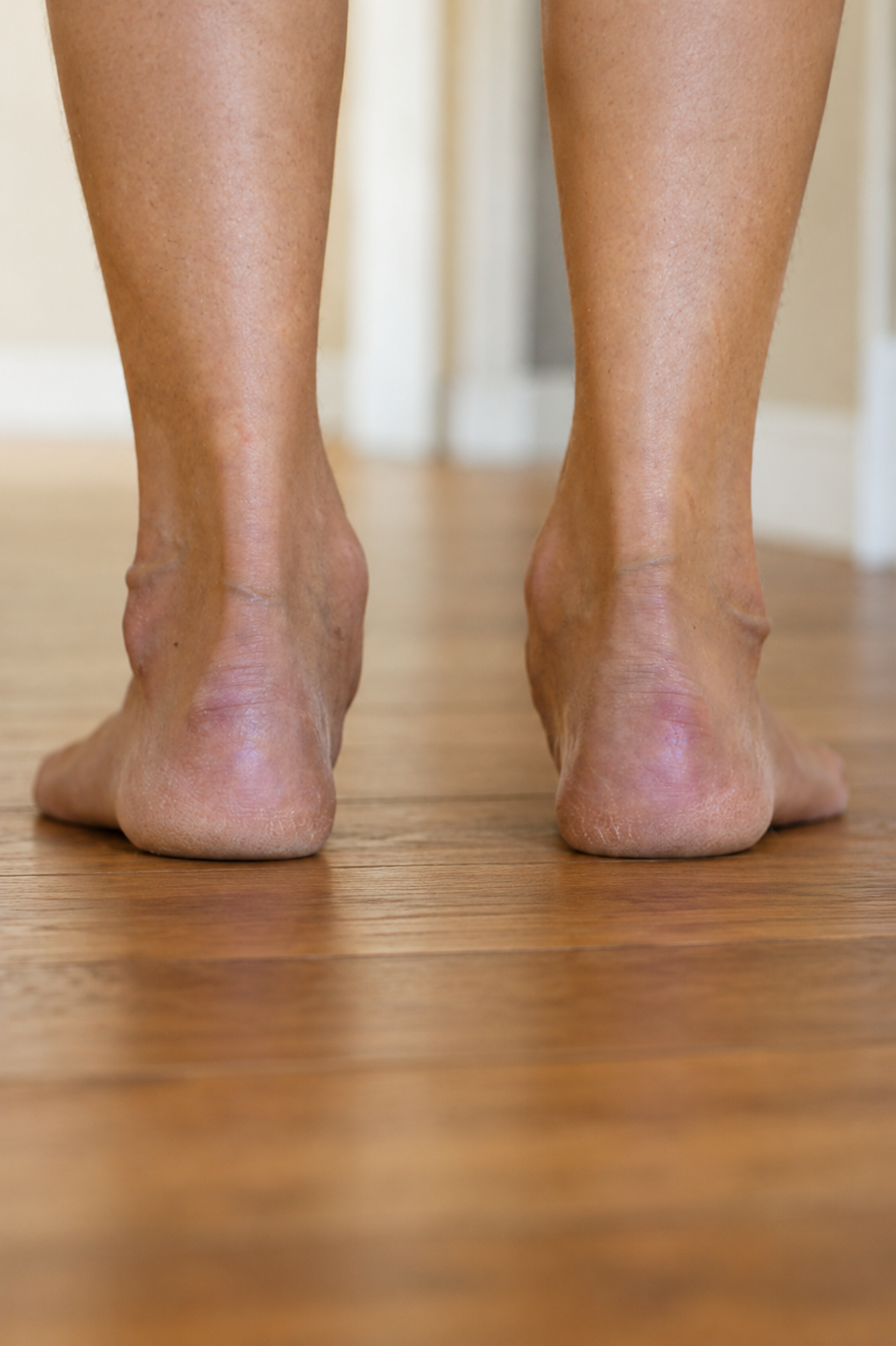 Flat Feet and Overpronation: What’s Actually Going On