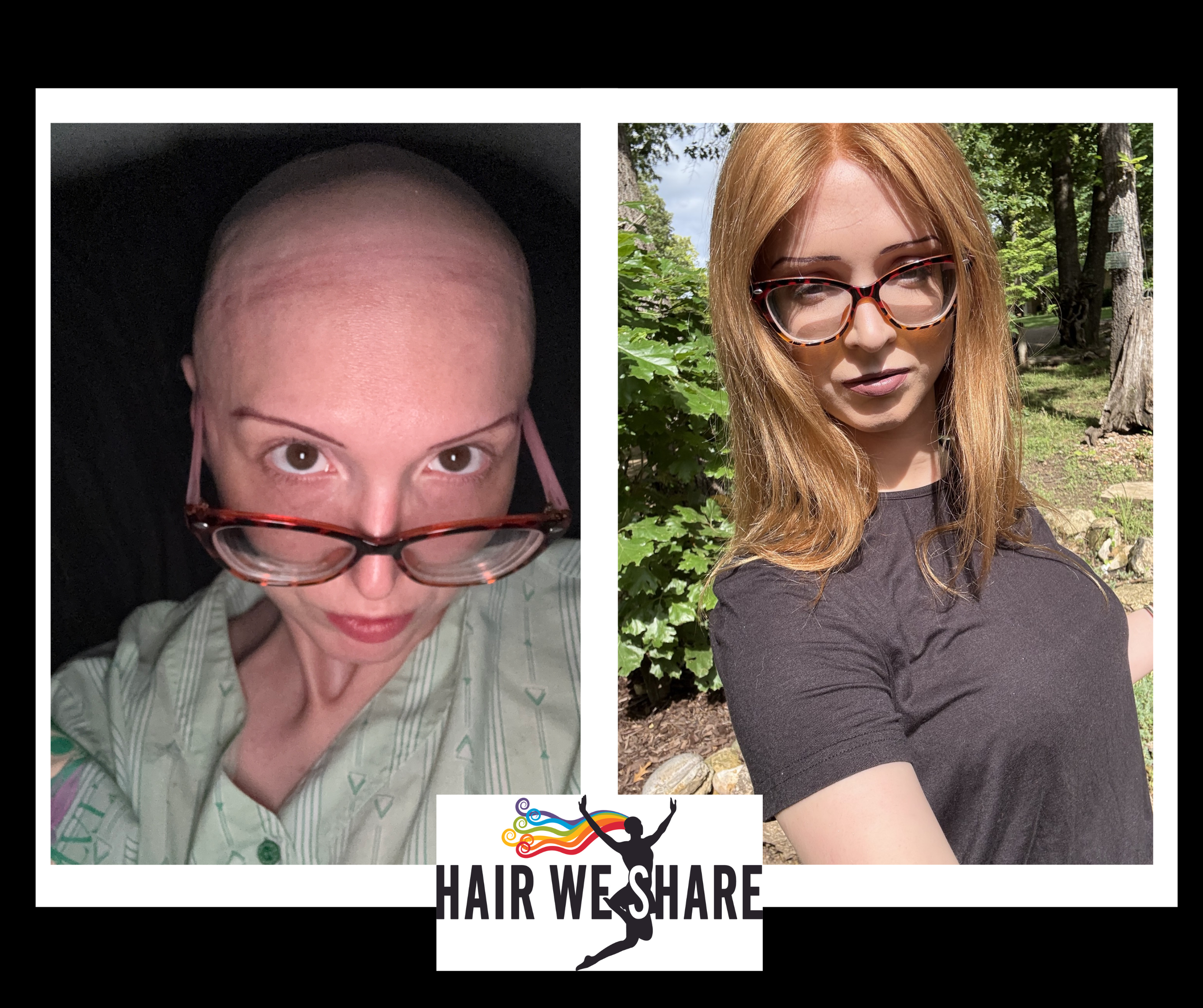 The Emotional Side of Hair Loss — Hair We Share