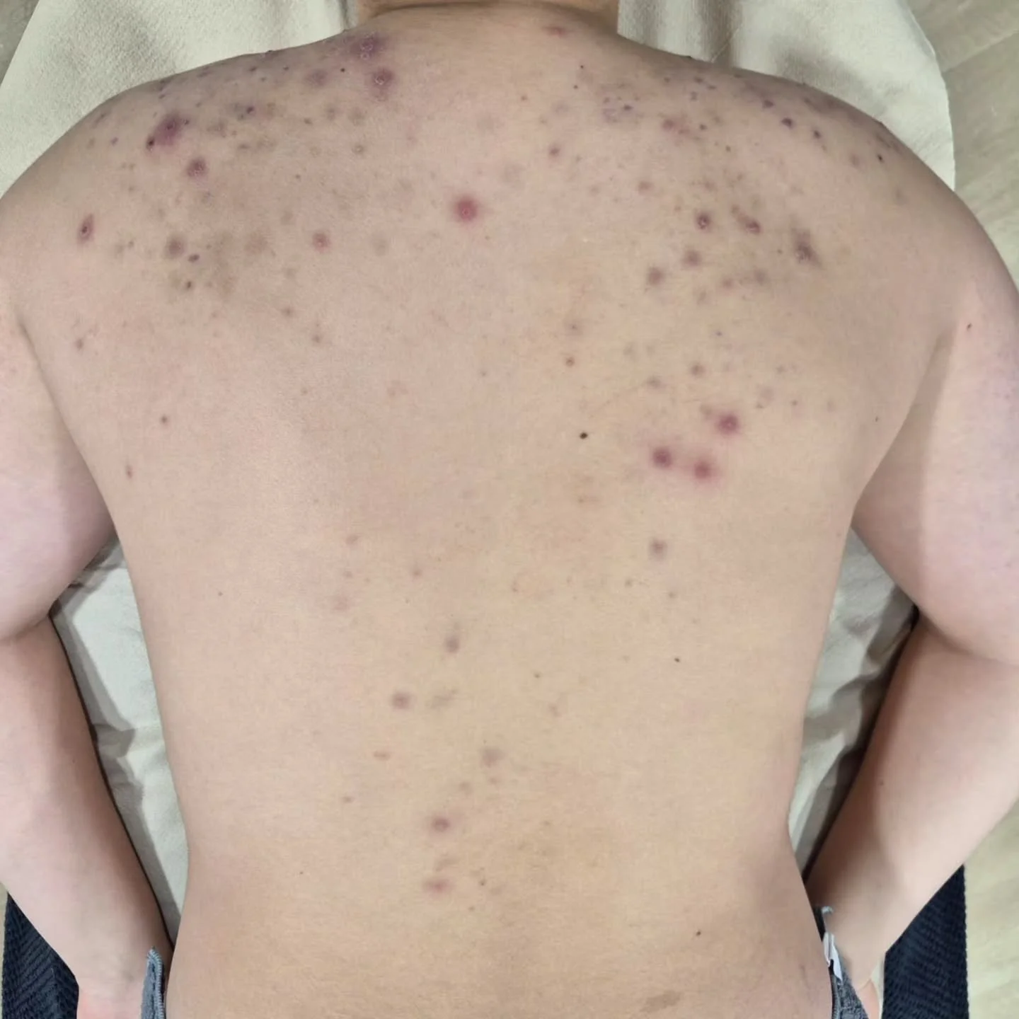 BEFORE > AFTER 
*Four treatments over four weeks*

The Back Facial, for acne prone skin.

Because breakouts don&rsquo;t just happen on your face. Our Back Facial is designed to deep-clean, exfoliate, and refresh the hard-to-reach skin on your back