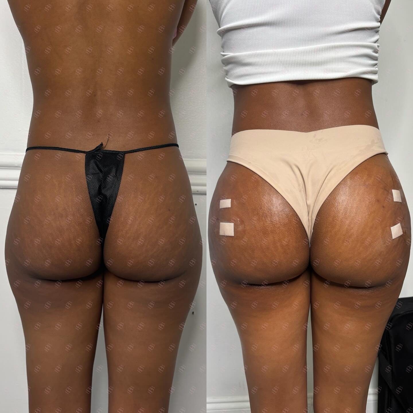 😍 SHE&rsquo;S GIVING SLIM THICK MAMIIIIII. ANOTHER BARBIE IS BIKINI READY FOR SUMMER WITH OUR LIQUID BBL!

This Barb completed (2) sessions of 400 mL each, totaling 800 mL for her transformation.

We used our HA filler to increase volume of the butt
