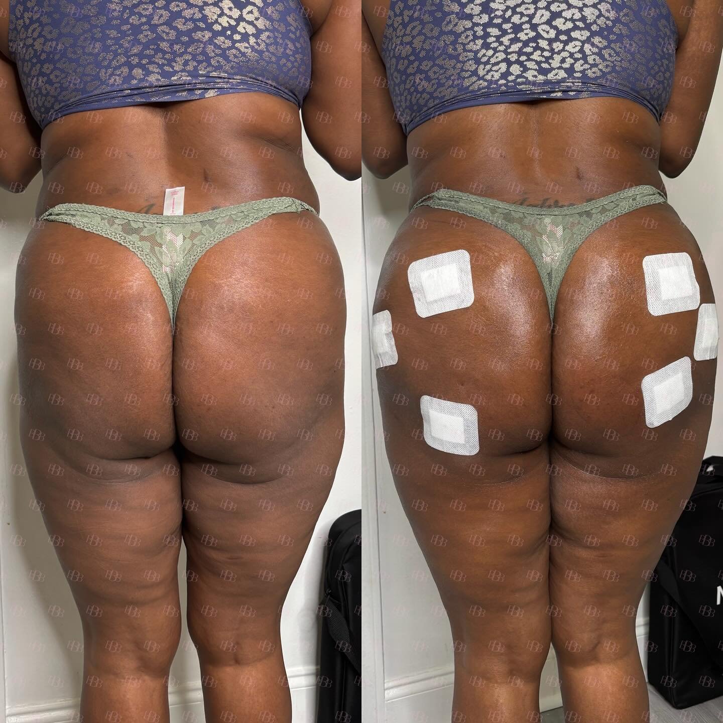 😍 YUM YUM IN HER BUM BUM. ANOTHER BARBIE IS BIKINI READY FOR SUMMER WITH OUR LIQUID BBL!

We used our HA filler to increase volume of the butt, provide projection AND fill in her hips and now she&rsquo;s summer ready! 

*the looser the skin the more