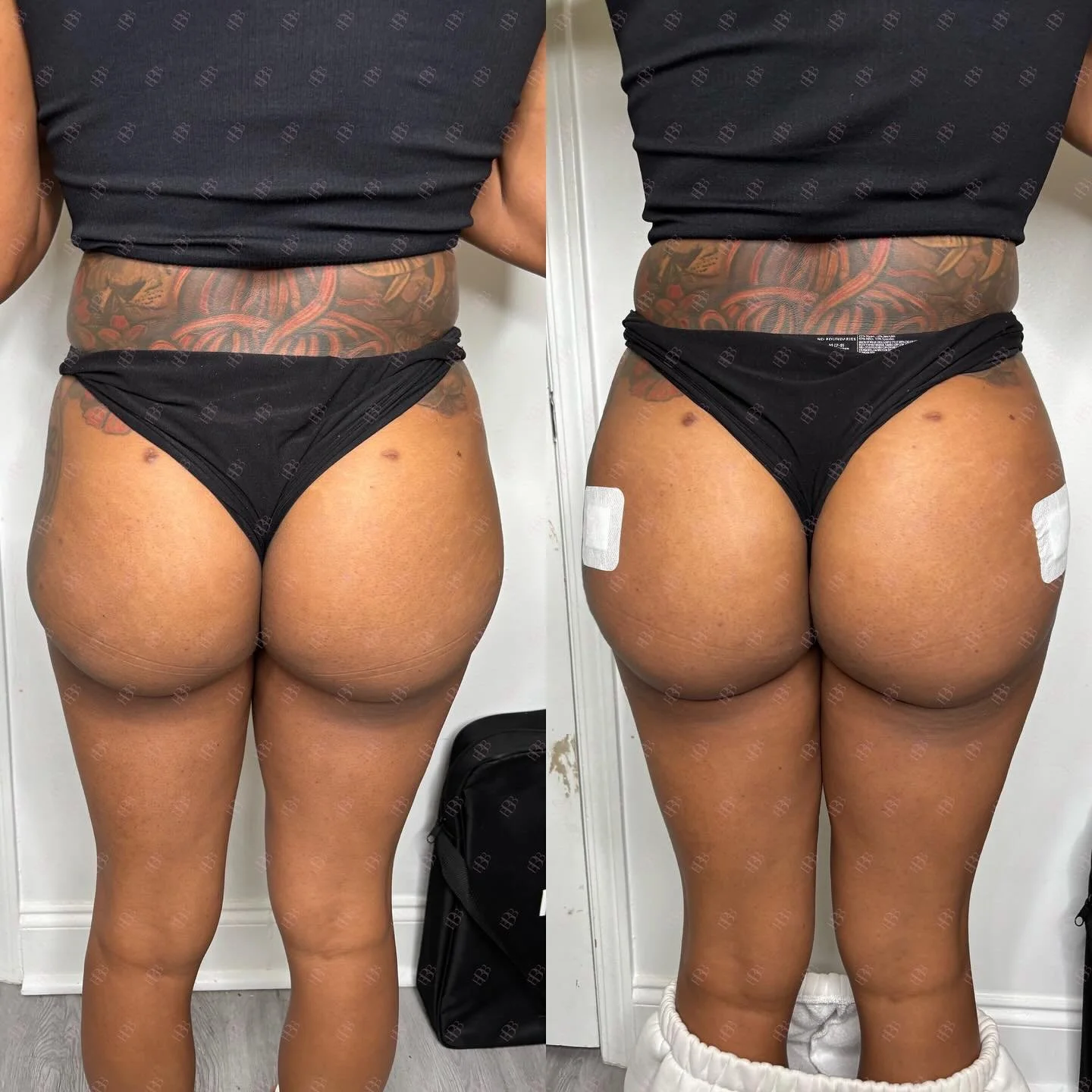 LIQUID BBLS ARE ON SALE! You&rsquo;re already a baddie, but you can even more confident by investing into your looks! 

ANOTHER BARBIE IS BADDIE READY WITH OUR LIQUID BBL! She wanted to even out some of the fat loss she had after a bbl and we got her