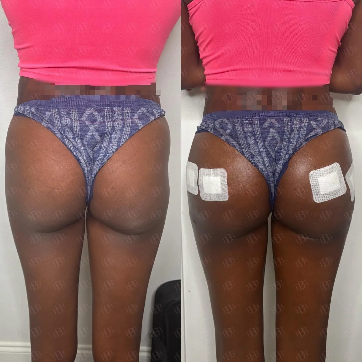 VOLUME &amp; LIFT w/ Liquid BBL.  She wanted a very natural and not overdone look so With 200 mL we gave her booty a lift &amp; gave her volume.

We used our HA filler to increase volume of the butt, provide projection AND fill in her hips and now sh