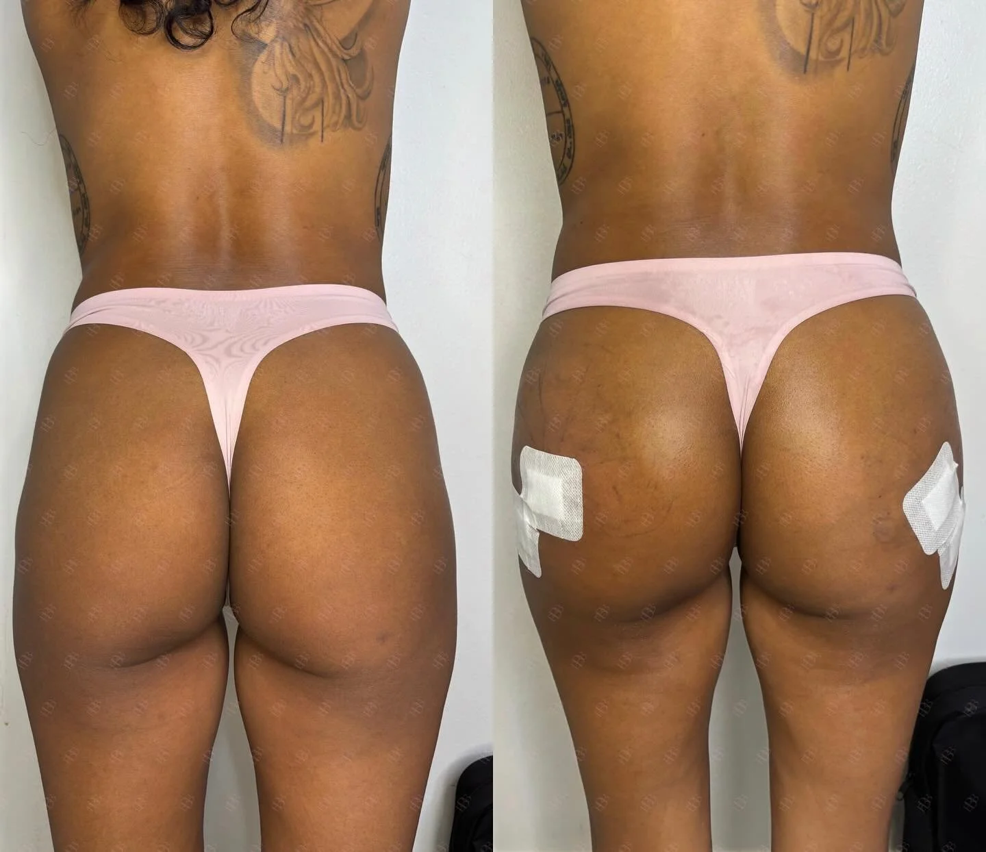 VOLUME &amp; LIFT w/ Liquid BBL.  She wanted a very natural and not overdone look so With 300 mL we gave her booty a lift &amp; gave her volume.

We used our HA filler to increase volume of the butt, provide projection AND fill in her hips and now sh