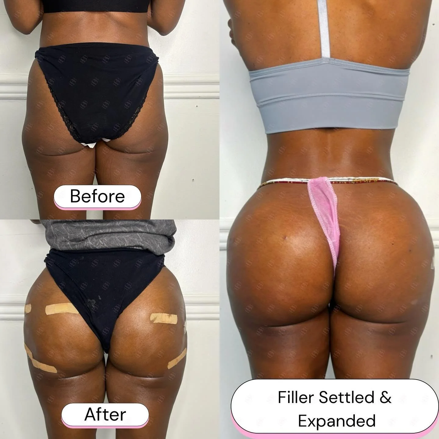 The Results Just Get Better. ✨ Right after your Liquid BBL, you&rsquo;ll see instant volume and shape &mdash; but that&rsquo;s just the preview. As the filler settles and expands, your results smooth out, lift beautifully, and become even more define