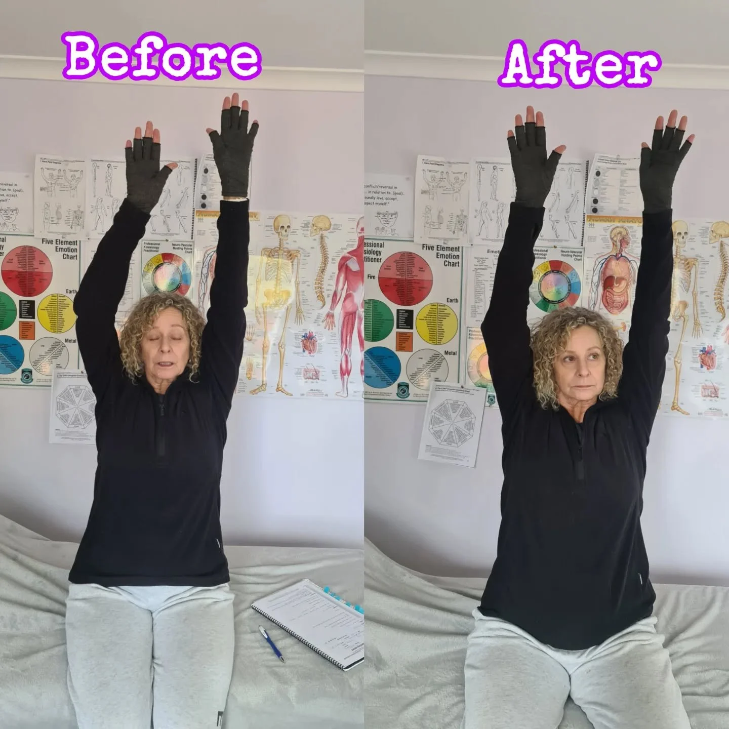 β¨ Frozen Shoulder Breakthrough! β¨
Check out this incredible before & after from a kinesiology session I had with my client experiencing restricted shoulder movement due to frozen shoulder.
In the before photo, her range of motion was visibly li