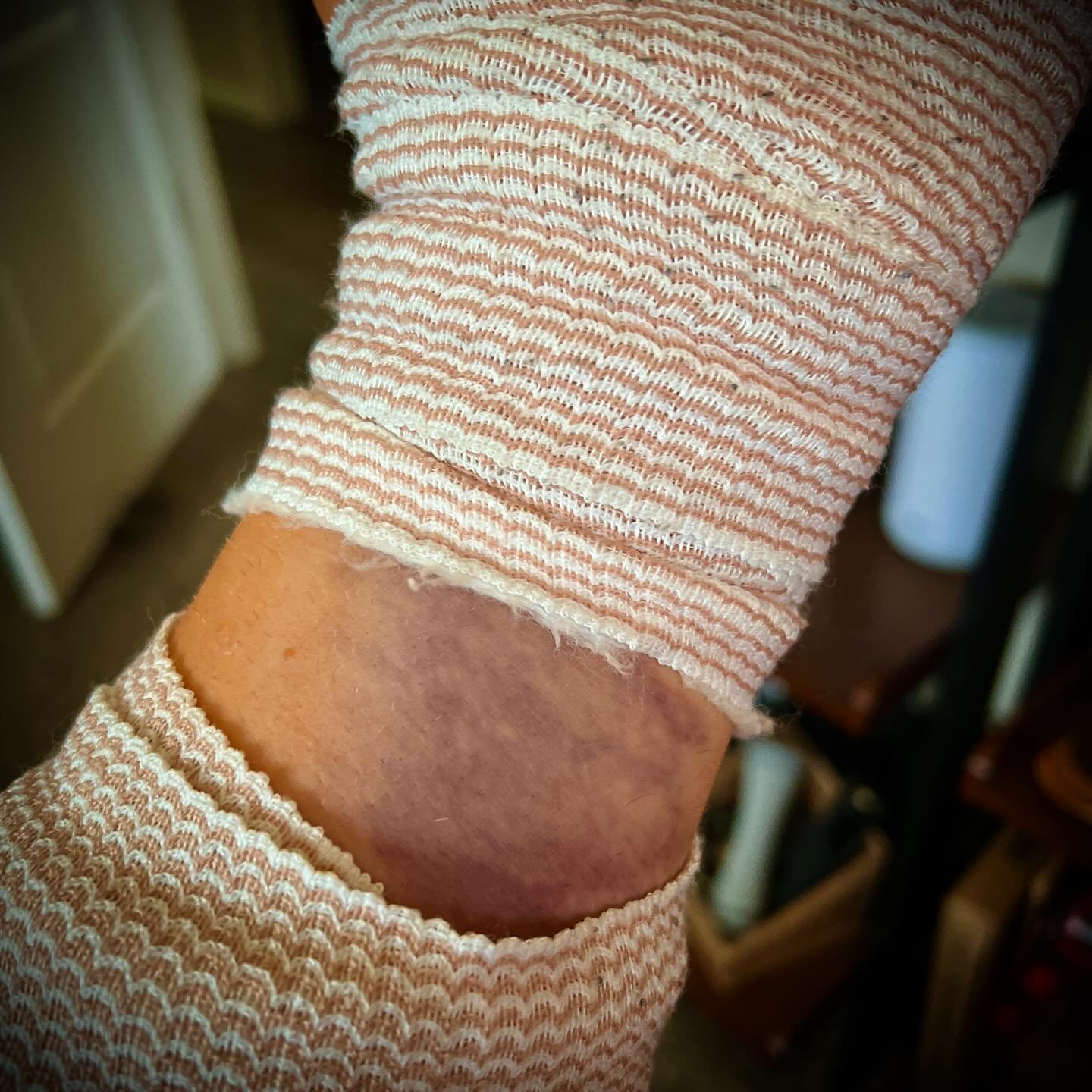 DANG!!! I had absolutely NO idea this bruise was even there! Had surgery on my left hand and arm, Wednesday (same procedure was done on the other hand and arm a month ago), and while the suture area on the heel of the palm just above the wrist kinda 