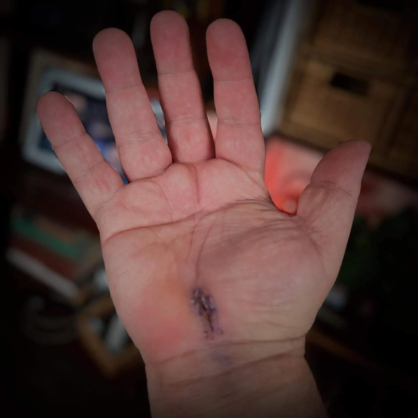 Post-op report on the right hand/arm surgery: MAGNIFICENT. All&rsquo;s well to proceed to the left arm and hand on the 25th! 💪