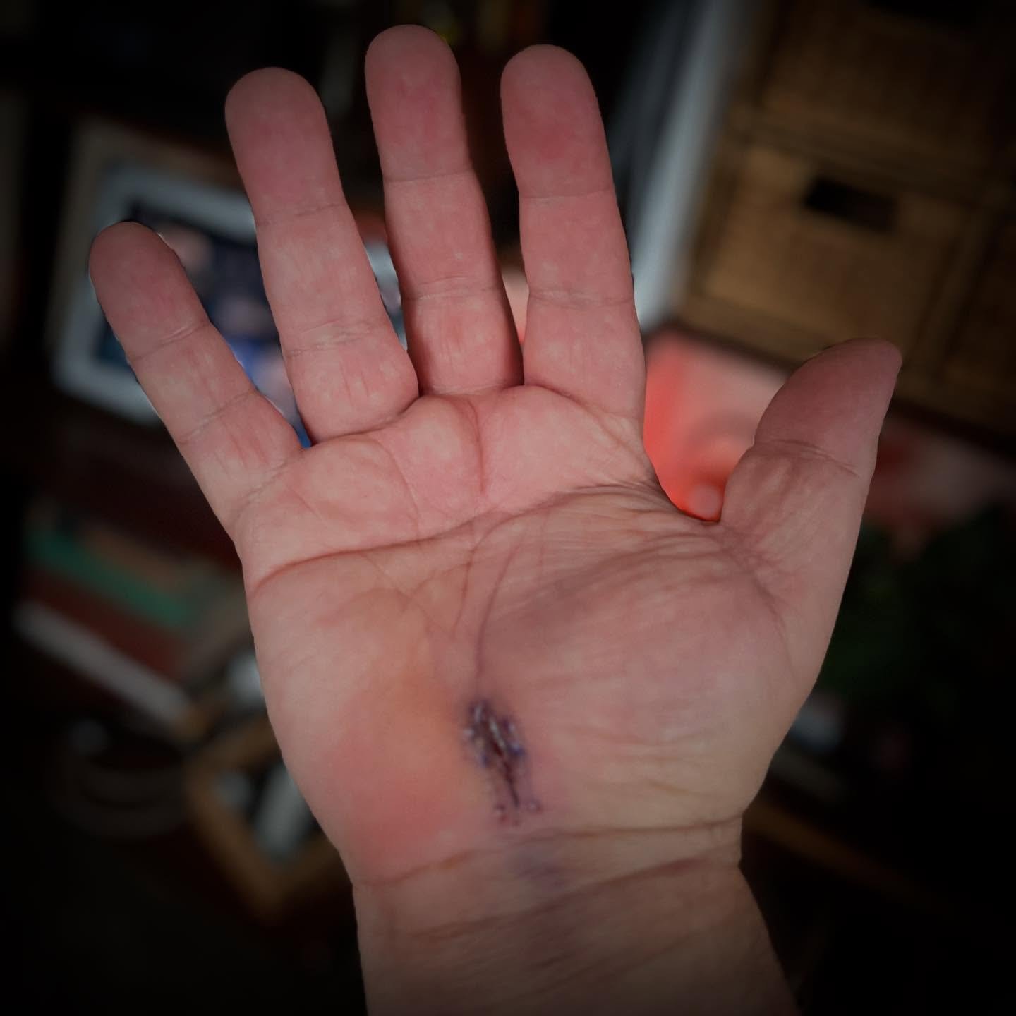 Post-op report on the right hand/arm surgery: MAGNIFICENT. All&rsquo;s well to proceed to the left arm and hand on the 25th! 💪