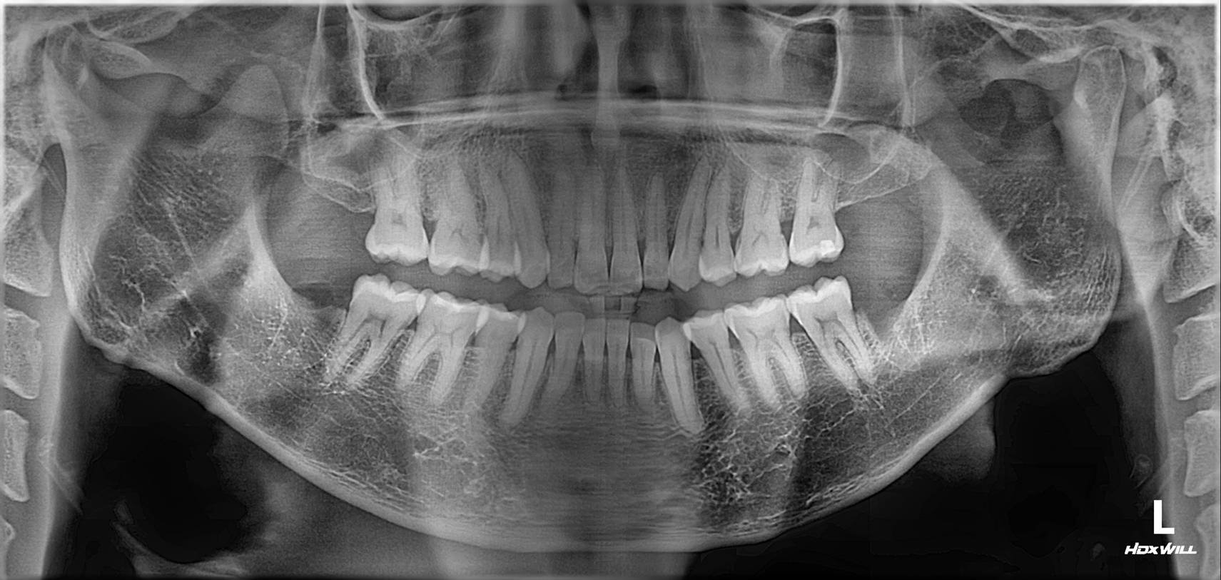 3rd molar extraction - After