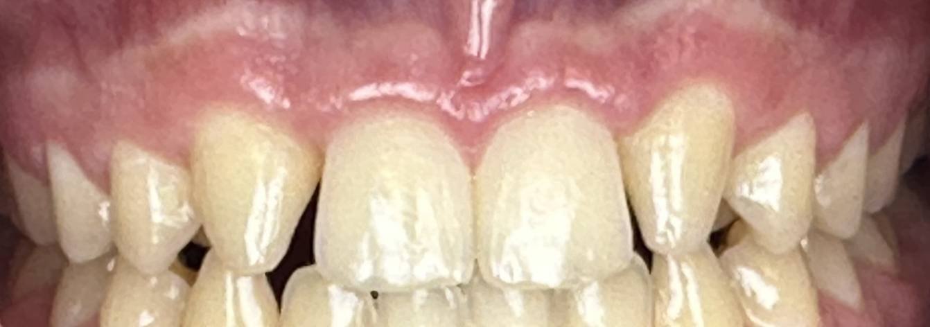Cosmetic Bonding - Composite Veneer - Before