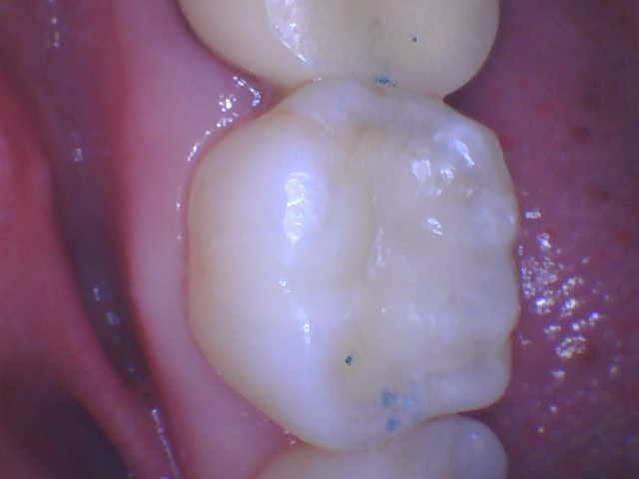 Tooth Color Posterior Filling - After
