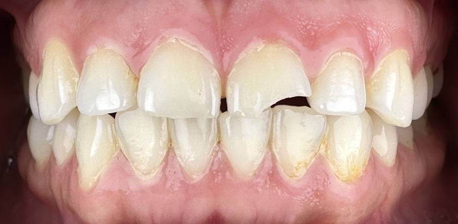 Tooth Colored Anterior Fillings - Before