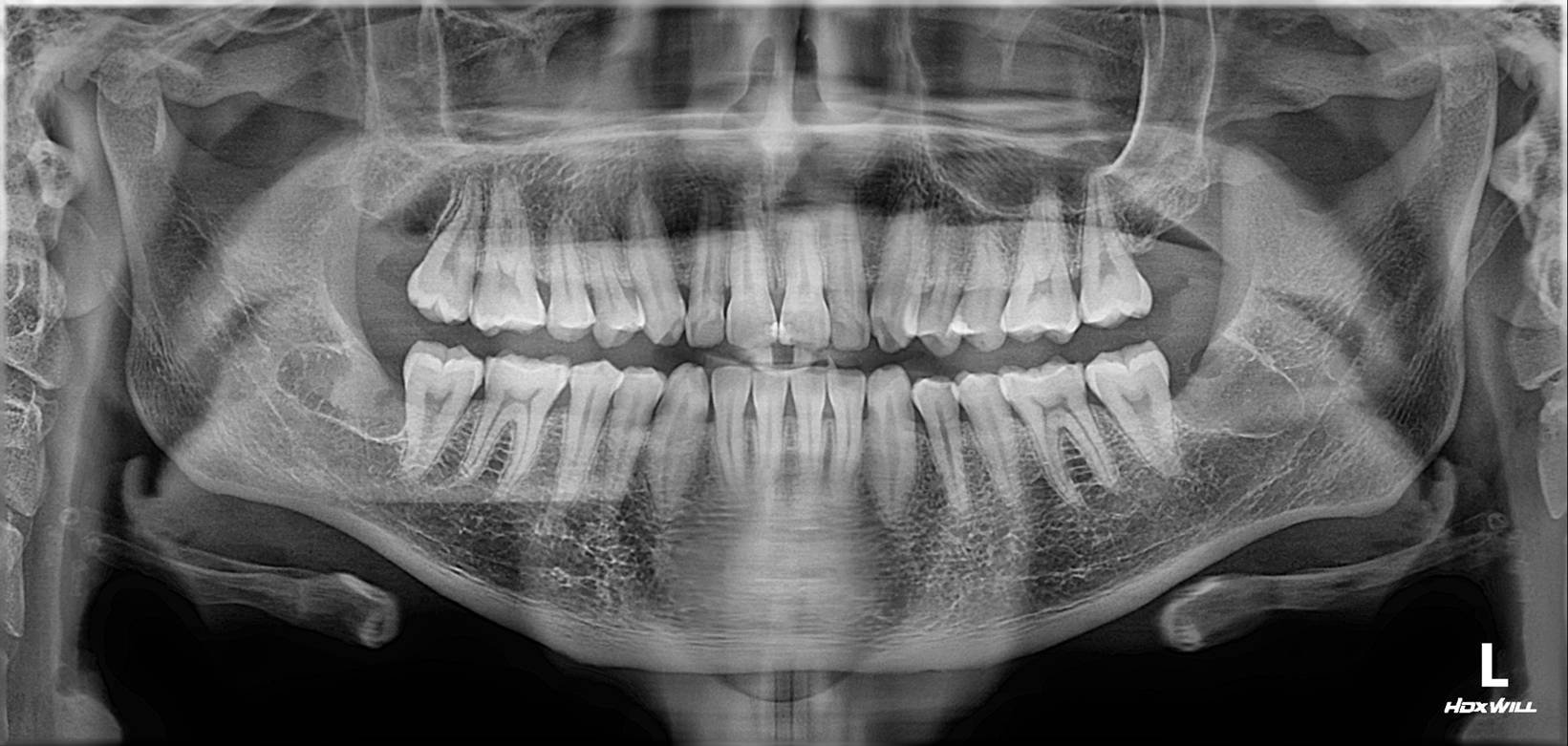 3rd molar extraction - After