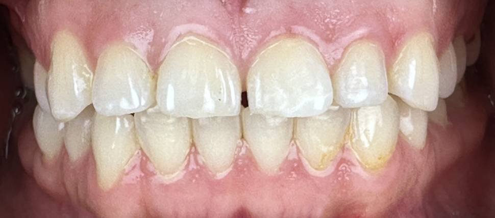 Tooth Colored Anterior Fillings - After