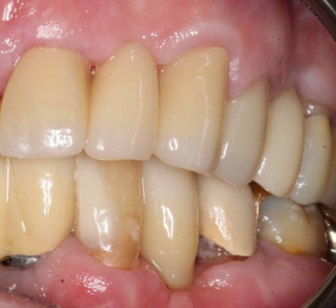Implant Placement & Restoration - After